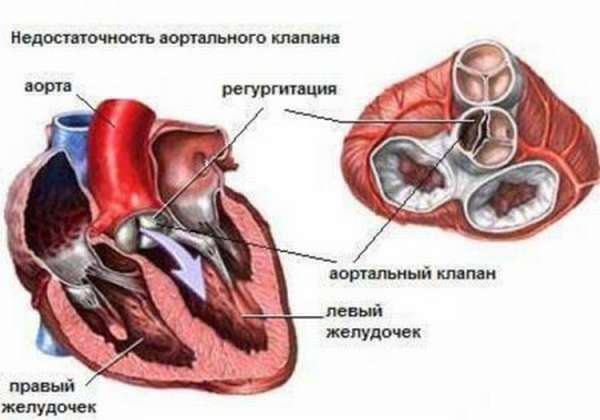 Особенности заболеваний клапана сердца, симптомы, диагностика и методы лечения