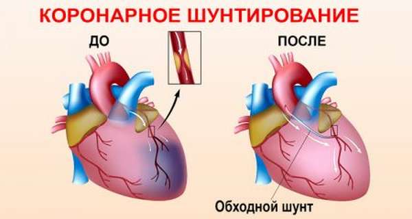 Переднесептальный инфаркт миокарда экг thumbnail