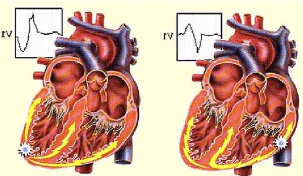 Что такое экстрасистолия сердца: симптомы, лечение заболевания
