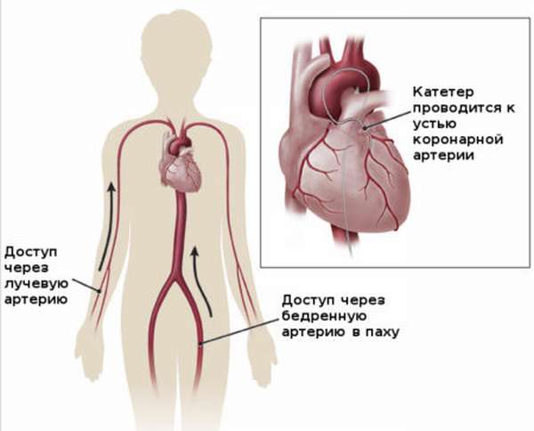 Последствия коронарографии сосудов сердца, методы исследования и возможные осложнения