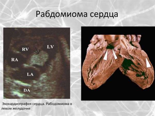 Доброкачественные и злокачественные опухоли сердца, их разновидность, симптомы и последствия развития, стоимость лечения