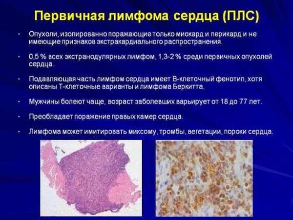 Доброкачественные и злокачественные опухоли сердца, их разновидность, симптомы и последствия развития, стоимость лечения