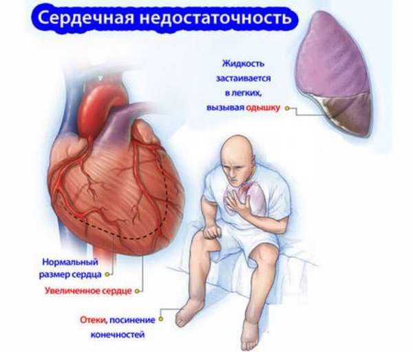 Симптомы сердечной недостаточности острого и хронического типа