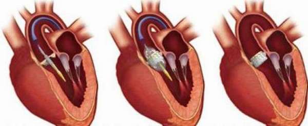 Основные виды пластики и коррекции митрального клапана сердца