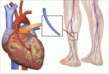 Каким образом делают операции при инфаркте миокарда: основные типы и их описание