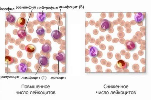 Отклонение лейкоцитов в анализе крови, причины и симптомы, правила для правильного забора крови