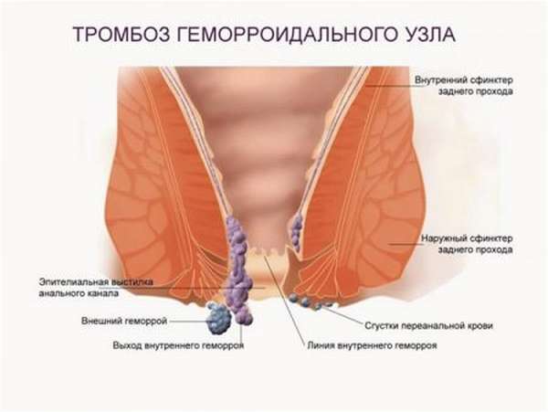 Симптомы тромбоза геморроидального узла, лечение заболевания, методы профилактики нарушения и его осложнений