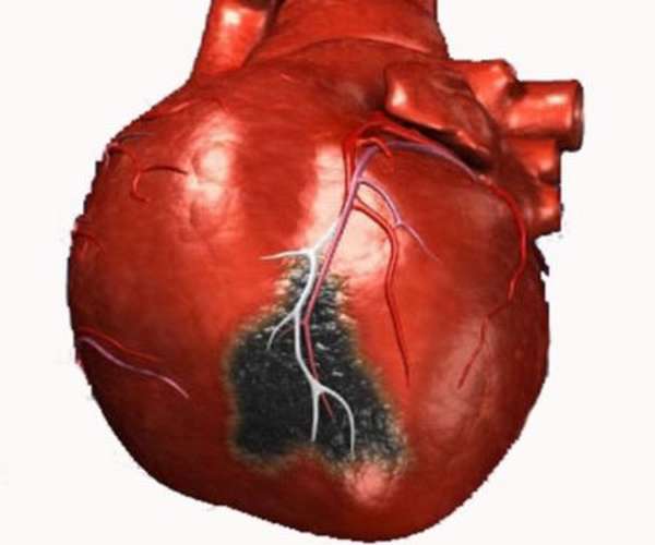 Характеристика инфаркта правого желудочка, причины болезни и методы терапии и профилактики