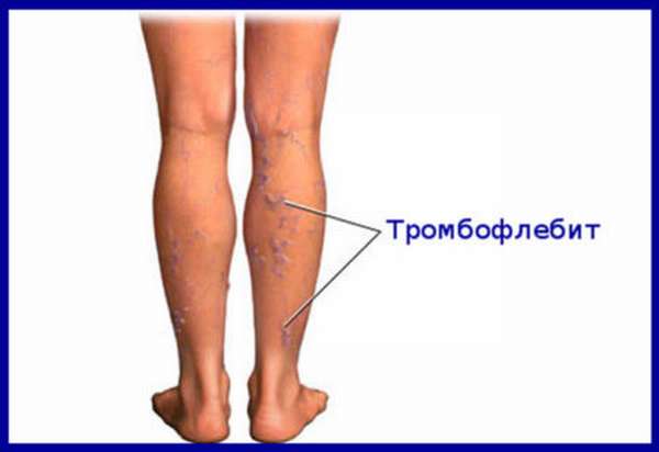 Диагностика тромбоза вен нижних конечностей: симптомы, патологическая диагностика и лечение