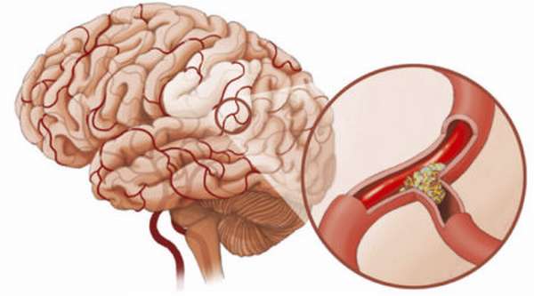 Симптомы сосудистой дистонии головного мозга, лечение и провоцирующие факторы