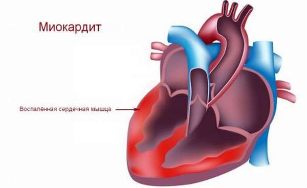 Симптомы и лечение хронической сердечной недостаточности: причины и классификация недуга