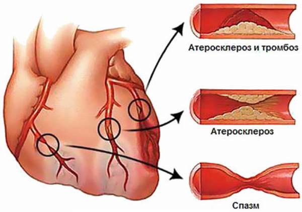 Причины обширного инфаркта миокарда и сопровождающие симптомы приступа