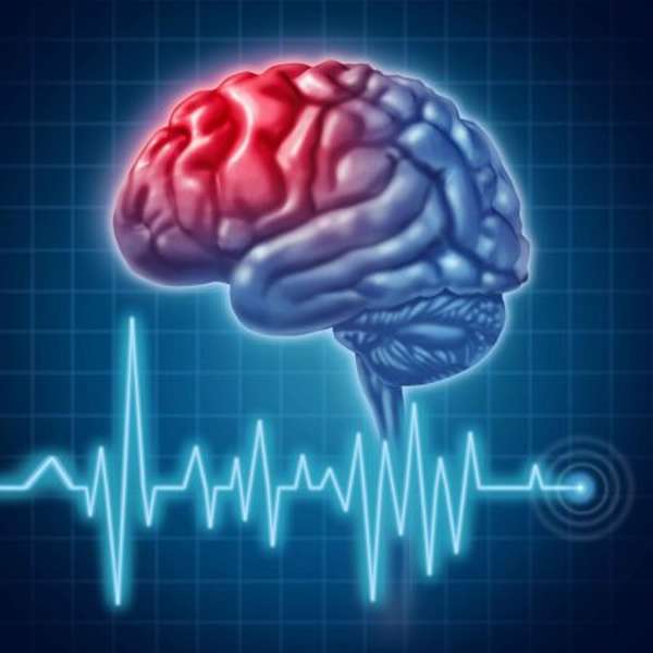 Последствия отека мозга после инсульта, рекомендации специалистов