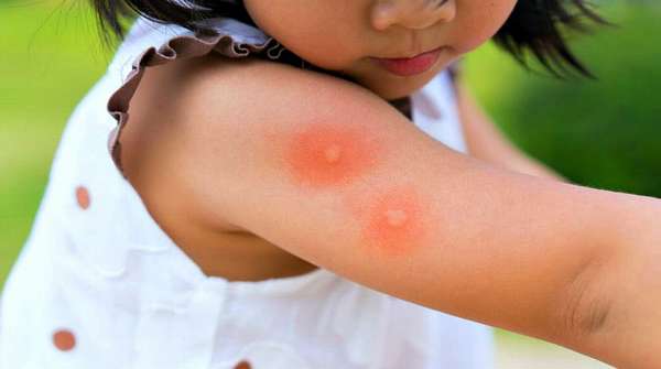 Укусы комаров у ребенка на теле