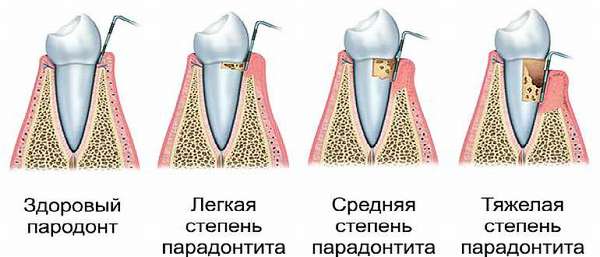 Степени болезни зубов