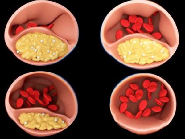 Помогает ли применение препарата «Атероклефит» от компании Эвалар в борьбе с повышенным уровнем холестерина?