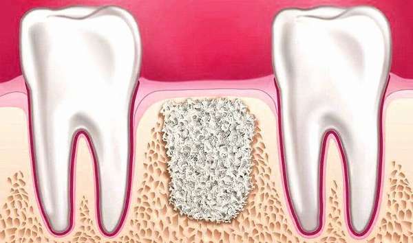 Эрозии костной ткани зубов