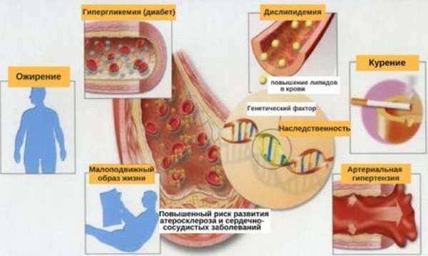 Симптомы атеросклероза сосудов шеи и эффективные способы лечения стеноза