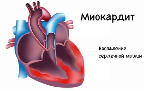 Почему на протяжении недели болит сердце? Распространенные причины, терапия и средства профилактики