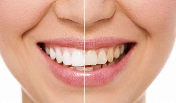 Отбеливание зубов и удаление зубного камня