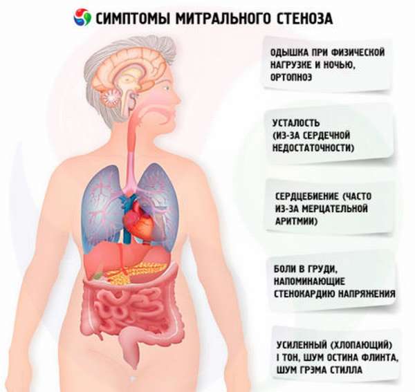 Причины появления митрального стеноза, основные симптомы и методы диагностики