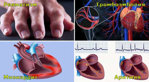 Почему возникают боли в области сердца после ангины? Способы устранения причин болей