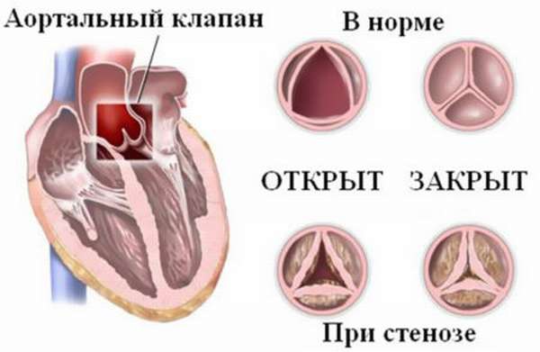 Диагностика сочетанного или комбинированного порока сердца, методы лечения