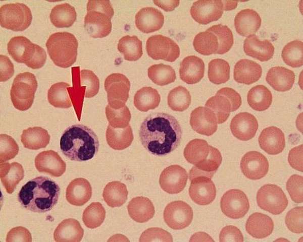 Чем вызывается появление незрелых гранулоцитов в крови человека?