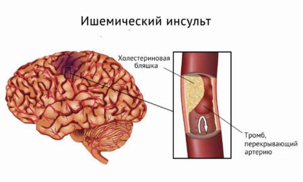 Причины возникновения аневризмы сосудов головного мозга, симптомы, диагностика, последствия и лечение