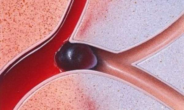 Диагностика тромбоза подколенной вены: симптомы, патологическое прогрессирование, лечение