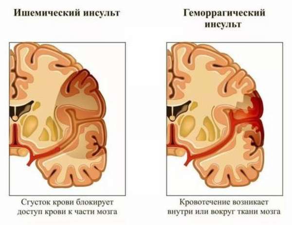 Рекомендации по профилактике инсультов головного мозга у мужчин