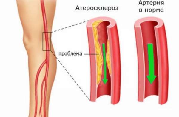 Что необходимо знать о нестенозирующем атеросклерозе артерий нижних конечностей, признаки и симптомы