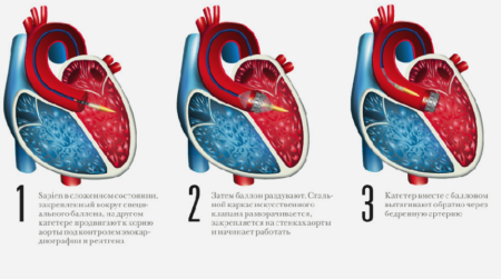 Причины возникновения систолического шума в сердце