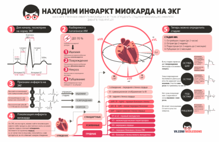 Принцип проведения диагностики и подтверждения диагноза инфаркта миокарда
