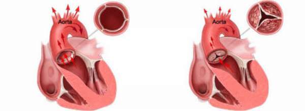 Формы, скорость и симптомы развития кальциноза аортального и митрального клапана сердца