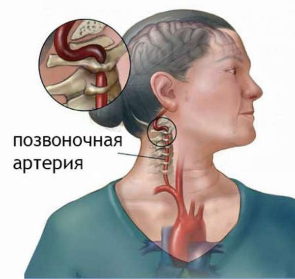 Опасность гипоплазии позвоночной артерии справа, меры профилактики болезни
