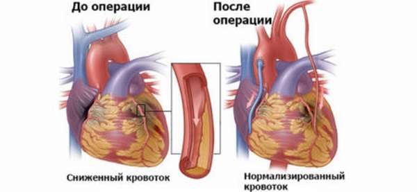 Методики ЛФК при различных заболевании сердечно-сосудистой системы, эффективность и продолжительность терапии