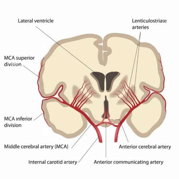 Причины возникновения гипоплазии артерии головного мозга, методы диагностики, лечение и симптоматика