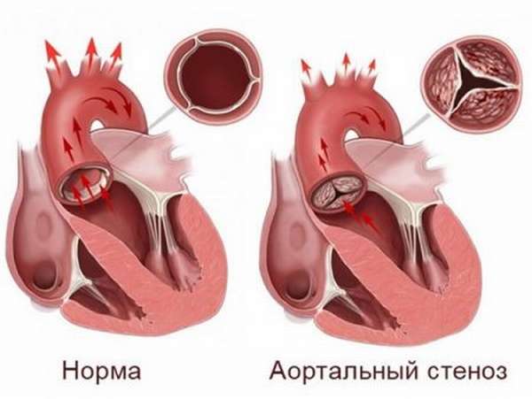 Отличия приобретенных пороков сердца от врожденных, виды и симптомы патологий, лечение