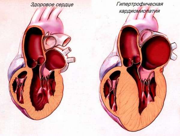 Особенности ишемической дилатационной кардиомиопатии, методы лечения