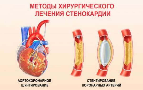 Чем проявляется, как диагностировать и лечить ишемическую болезнь сердца