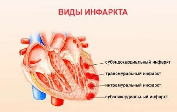 Отличие крупноочагового трансмурального инфаркта миокарда от субэндокардиального, терапия, реабилитация, прогноз