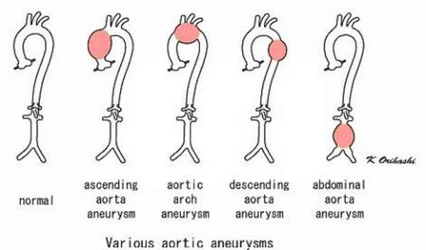 Причины разрыва аорты сердца и брюшной полости, симптомы и проявление