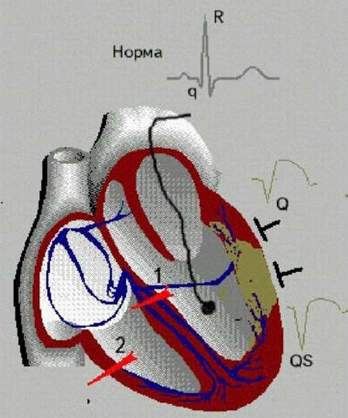 Отличие крупноочагового трансмурального инфаркта миокарда от субэндокардиального, терапия, реабилитация, прогноз