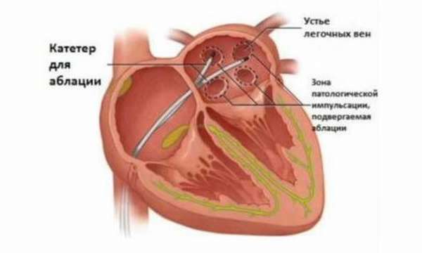 Причины учащенного сердцебиения при нормальном артериальном давлении