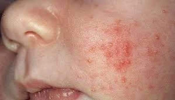 Сыпь при аллергии на цитрусовые