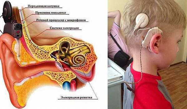 В каких случаях прихо­дится отказаться от попыток вернуть слух и задуматься о слуховом аппарате?