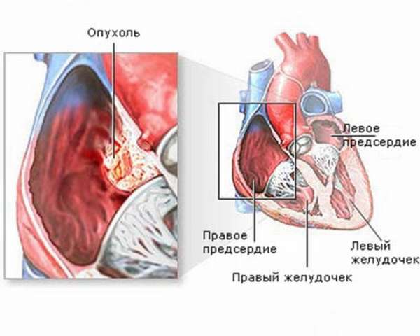 Доброкачественные и злокачественные опухоли сердца, их разновидность, симптомы и последствия развития, стоимость лечения