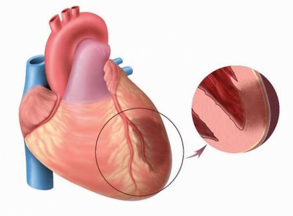 Основные причины приступа трансмурального инфаркта и его признаки