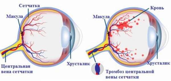 Возникновение тромбоза ЦВС глаза – диагностирование патологии, лечение, осложняющие факторы